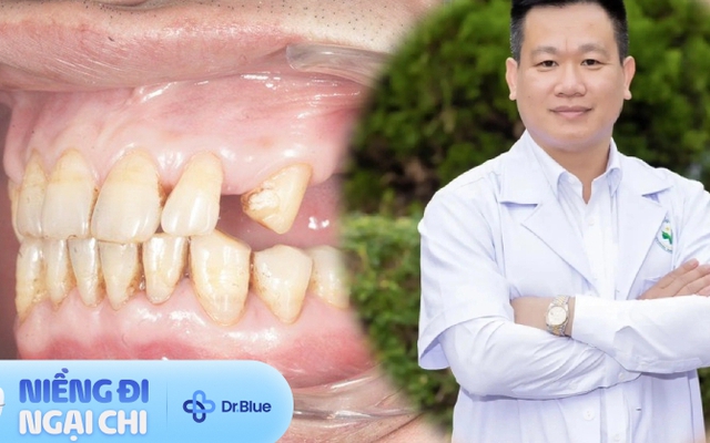 Mới 40 tuổi đã phải ăn đồ mềm như em bé do hệ luỵ của 1 thói quen tưởng chừng không làm mất răng