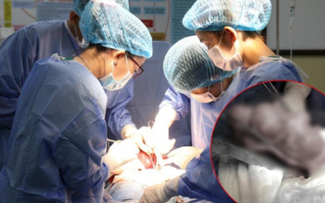 Người phụ nữ ở Bạc Liêu bỗng đau bụng dữ dội, phẫu thuật lấy ra được một thứ nặng đến 900 gram