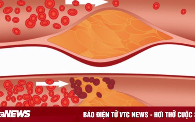 3 cách cực nhanh giúp bạn biết mình có nguy cơ tắc nghẽn mạch máu hay không