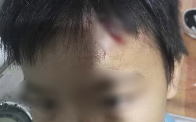 Điều tra vụ bé trai 10 tuổi nghi bị mẹ kế tiếp tục bạo hành