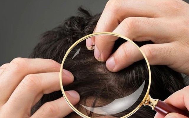 Không phải cứ có tóc bạc là lão hóa: Có 2 loại tóc trắng này trên đầu thì bạn cần đi khám sớm xem có mắc bệnh nào không