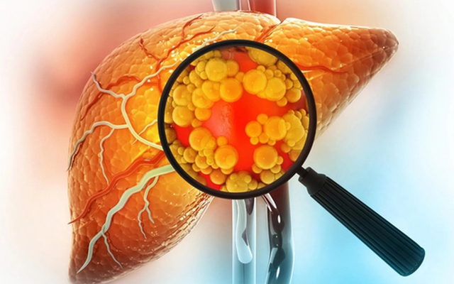 Tiêu thụ quá nhiều 2 đồ uống này, đừng trách vì sao gan ngập trong mỡ: Nghiên cứu mới đưa ra bằng chứng