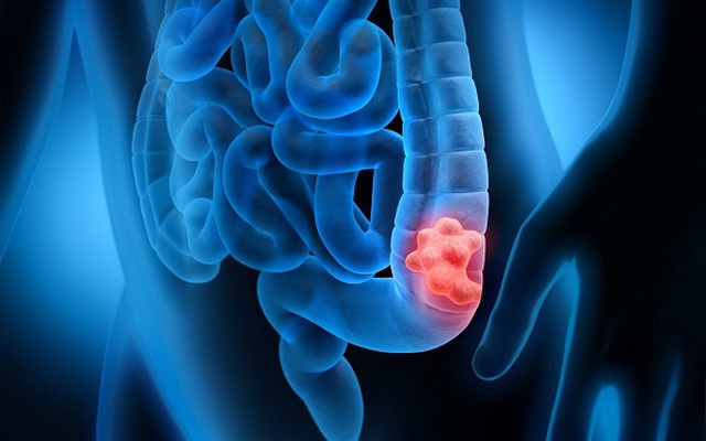 Cảnh báo: Yếu tố này khiến một người gần như chắc chắn mắc ung thư đại tràng nếu không được phát hiện