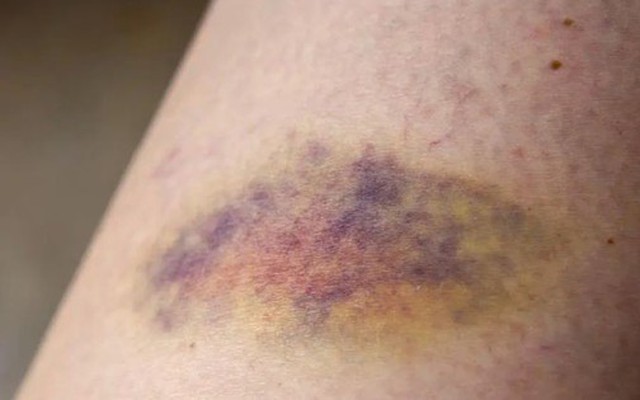 1 dấu hiệu trên da có thể cảnh báo ung thư "cận kề": Bác sĩ khuyên nếu thấy nên đi khám ngay