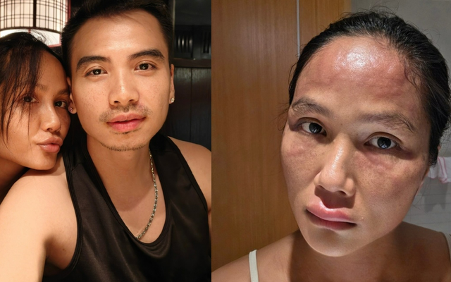 Hoa hậu H'Hen Niê sau khi bị biến dạng mặt