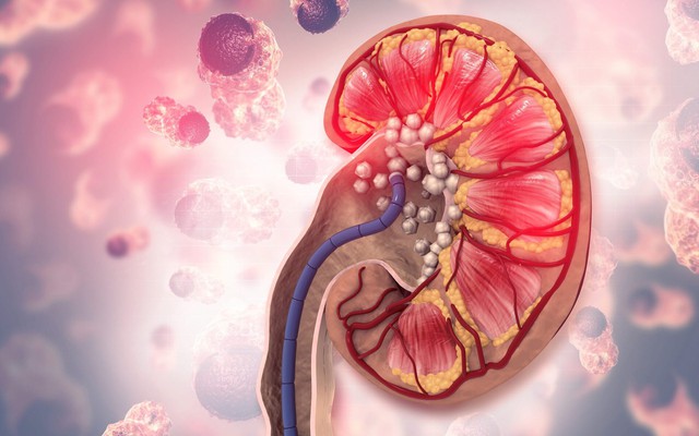 Người có axit uric máu cao thường có 3 đặc điểm này khi ăn uống: Có 1 cũng khiến thận sớm suy hỏng