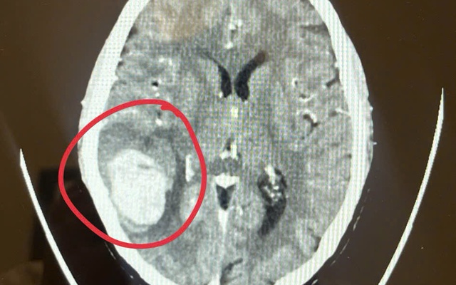 Phát hiện dấu hiệu lạ ở mặt khi đi chợ sớm, bệnh nhân làm ngay 1 việc khiến bác sĩ khen “quá sáng suốt”