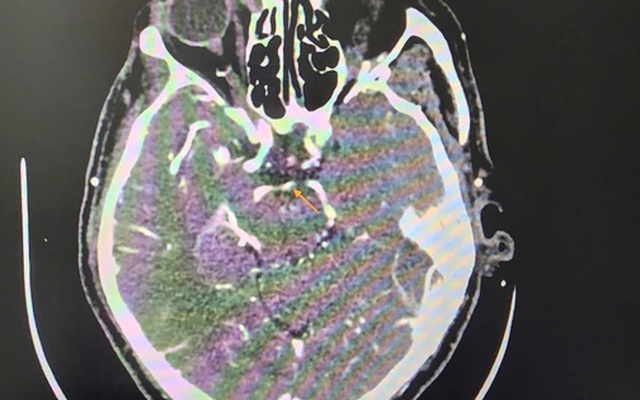 Đột quỵ khi uống bia, người đàn ông thoát chết ngoạn mục