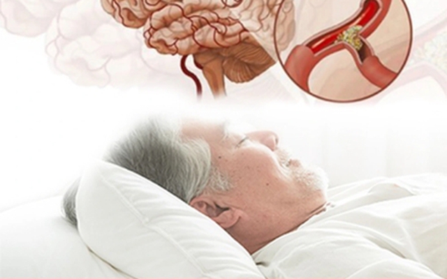 Cảnh báo nguy cơ đột tử do ngủ ngáy kéo dài