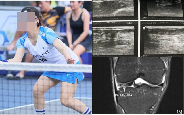 Cố gắng cứu bóng khi chơi pickleball, nhiều người phải cấp cứu