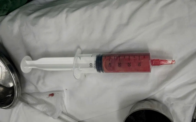 Cảnh báo biến chứng nặng sau khi tiêm chất làm đầy không rõ nguồn gốc