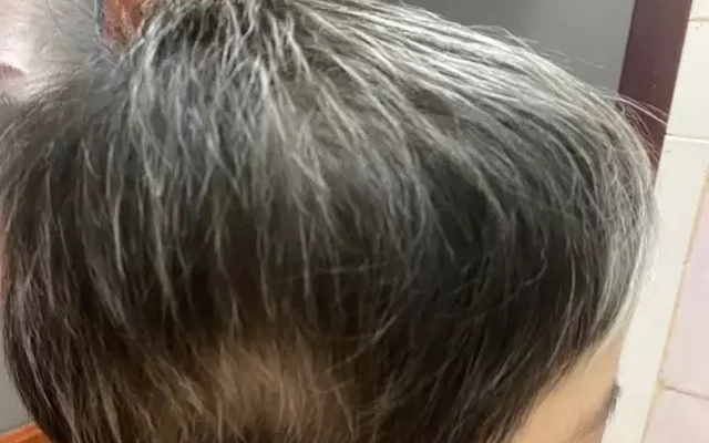 Điều trị thành công cho bệnh nhân 7 tuổi rụng toàn bộ tóc