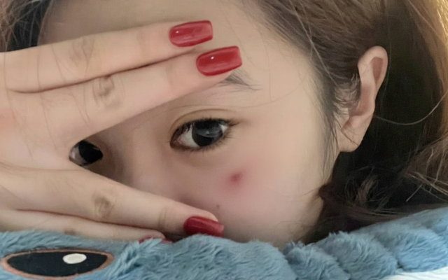 Một bất thường trên da đang cố TỐ CÁO ung thư máu nhưng lại bị đổ cho "đi đứng vụng về"