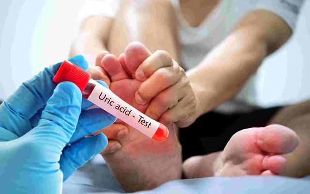 "1 giảm – 2 tăng" giúp kiểm soát acid uric tự nhiên không cần thuốc