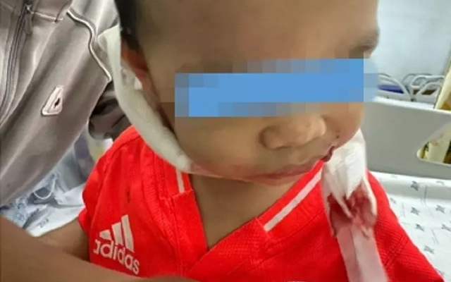 Bé trai 2 tuổi bị chó nhà nuôi cắn nhiều vết trên mặt