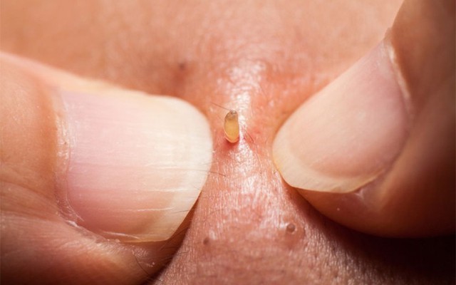 7 lý do nhiều người nghiện xem clip nặn mụn dù trông rất ghê