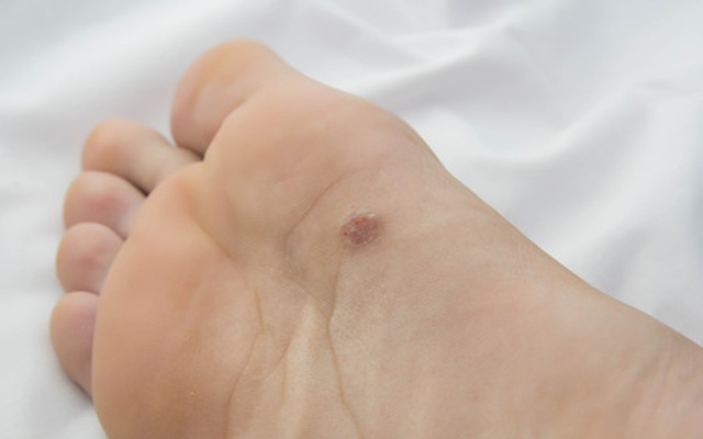 Có dấu hiệu lạ ở lòng bàn chân, người đàn ông làm ngay 1 việc: Được bác sĩ khen vì phát hiện ung thư sớm