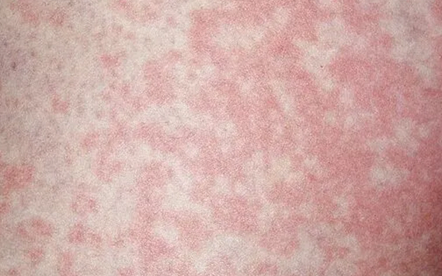 Người đàn ông nhiễm nấm vùng kín vì thói quen nhiều người làm với đồ lót của mình