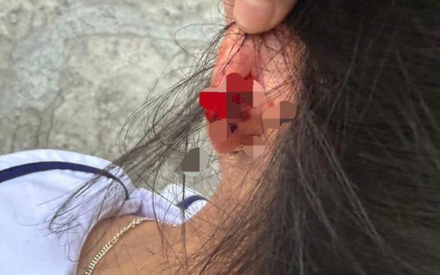 Xác minh vụ cô giáo ở Phú Quốc nhéo tai học sinh lớp 1 đến chảy máu