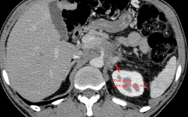 21 ngày 'bỏ đói' cơ thể, người đàn ông Hà Nội nhận kết quả khiến bác sĩ cảnh báo khẩn
