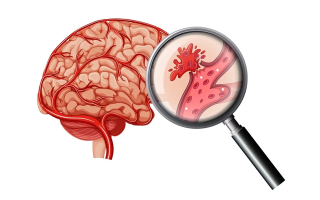 Đau đầu có thể không phải là dấu hiệu sớm nhất của xuất huyết não: Gặp 5 triệu chứng này cần đi viện ngay