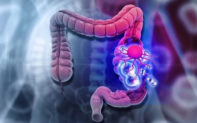 Ung thư đại trực tràng ở người trẻ ngày càng gia tăng, "ác tính mạnh": Nguyên nhân chính là 2 điều này