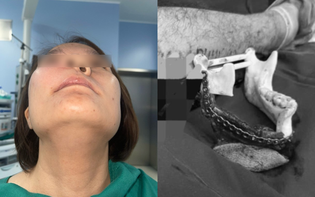 Cô gái 30 tuổi phải cắt bỏ một nửa xương hàm trên: Nguyên nhân được hé lộ