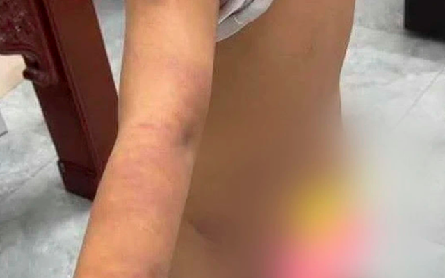 Làm rõ nghi vấn nam sinh lớp 6 bị bạo hành với nhiều vết bầm tím trên cơ thể