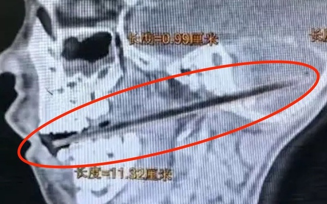 Bị ngã khi ngậm kẹo, cậu bé 6 tuổi bị que kẹo dài 11cm xuyên vào não