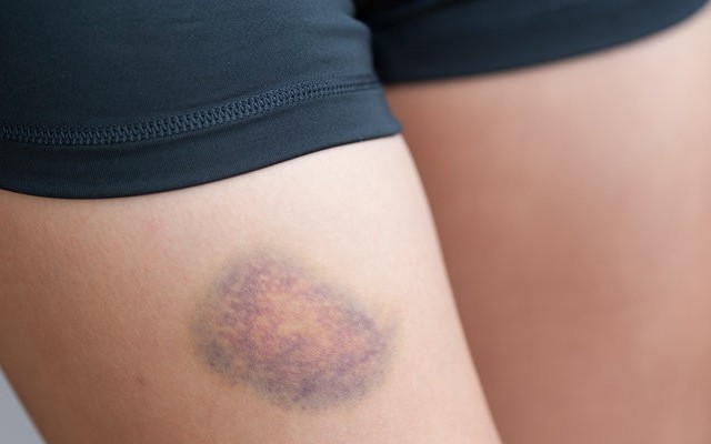 Bị bầm tím ngay cả khi hoạt động bình thường: Nhiều người bỏ qua nhưng BS cảnh báo khả năng mắc bệnh về máu này!