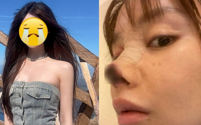 Mỹ nhân 9X bị hoại tử, rụng chóp mũi vì gặp biến chứng thẩm mỹ kinh hoàng nhất showbiz giờ ra sao?
