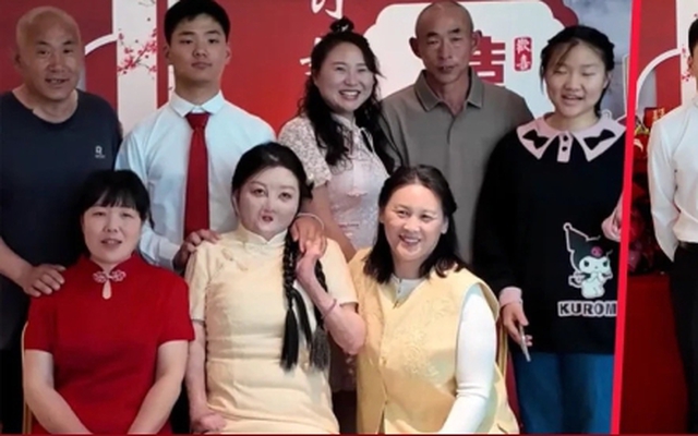 Duyên phận kỳ lạ của cô gái bỏng 95% cơ thể với người chồng sinh cùng ngày