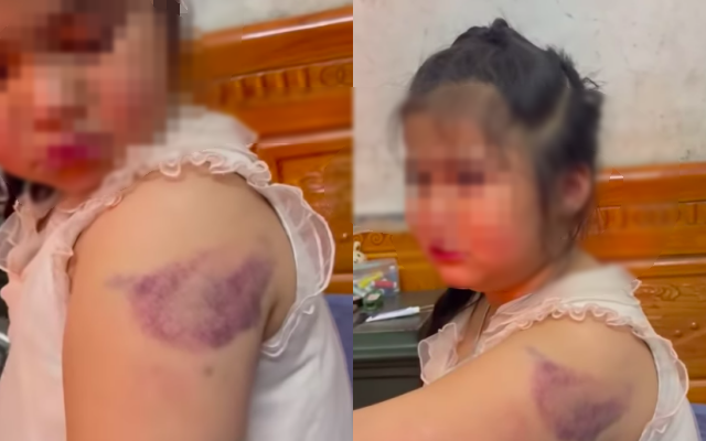 Clip 32 giây vụ học sinh lớp 1 nghi bị cô giáo đánh bầm tím tay vì viết chữ xấu