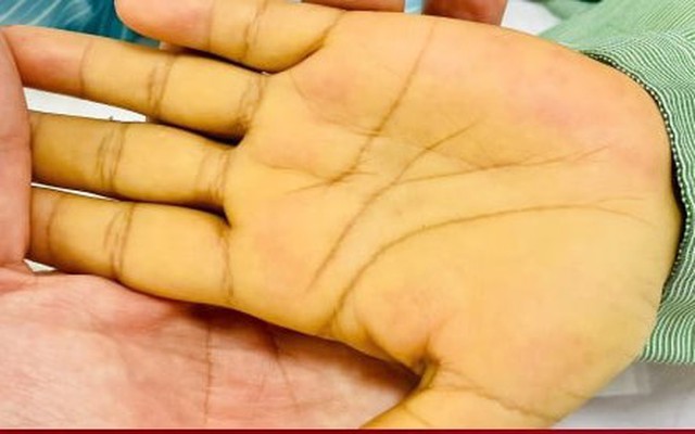 5 dấu hiệu nhận biết sớm ung thư gan không nên bỏ qua