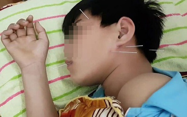 Bé 5 tuổi bị liệt nửa mặt đột ngột: Cảnh báo cha mẹ về căn bệnh trẻ có thể gặp do nằm quạt, điều hòa trong mùa hè