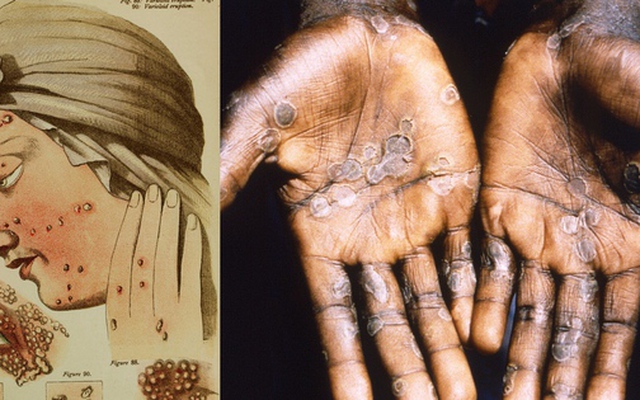 Căn bệnh này từng giết hàng trăm triệu người: Vì sao nhân loại bỗng dưng xóa sổ được chỉ sau vài thập kỷ?