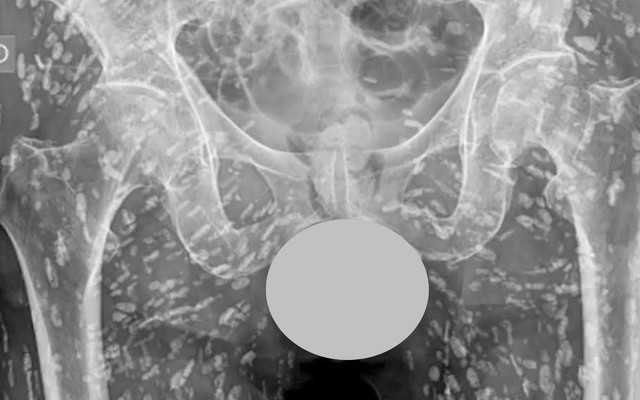 ‘Phát hoảng’ với ảnh chụp X-quang chi chít đốm trắng dọc cơ thể: Bác sĩ chỉ đích danh thủ phạm