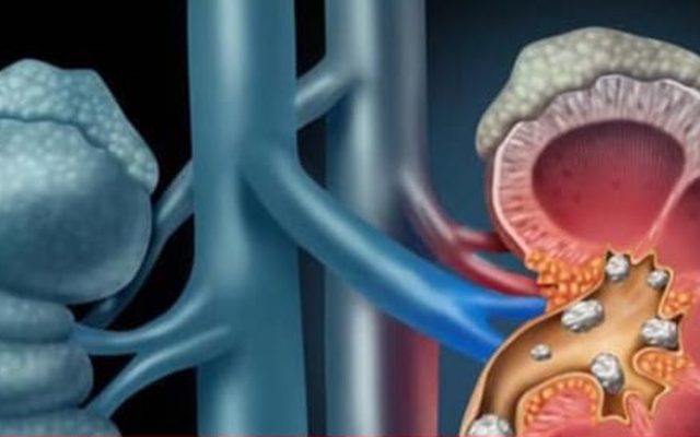 5 triệu chứng cảnh báo tổn thương thận không nên bỏ qua