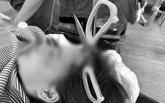 Kinh hãi cô gái 25 tuổi ở Quảng Ninh nhập viện với chiếc kéo sắc nhọn đâm xuyên sọ não