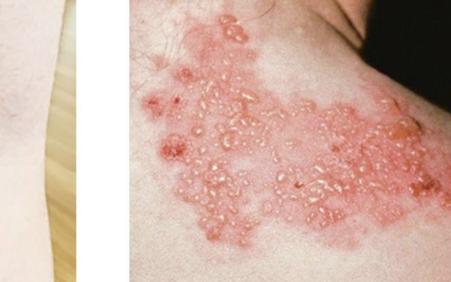 Báo động bệnh viêm não hiếm gặp tăng bất thường