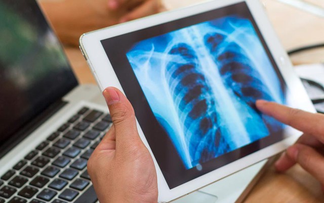 Chàng trai 24 tuổi có phổi 'già cỗi' như người 70, hối hận nói: "Thói quen này gần như lấy mạng tôi"