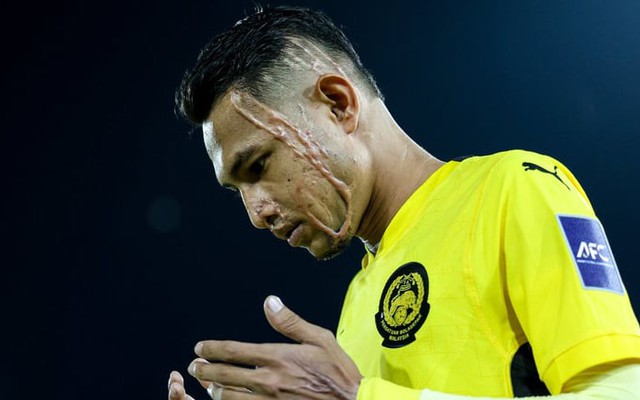 Bi kịch cầu thủ sắp đấu tuyển Việt Nam: Bị tạt axit, không thể cười bình thường