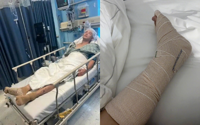 Kinh hoàng nam diễn viên số khổ nhất showbiz bị xe cán nát chân, liên tục lên bàn mổ để giữ mạng 2 năm qua