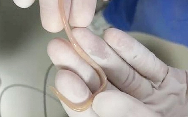 Con giun đũa sống dài 20cm được lấy ra khỏi cơ thể người phụ nữ