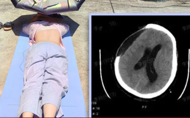 Tắm nắng cho khỏe, người phụ nữ bị xuất huyết não, hôn mê