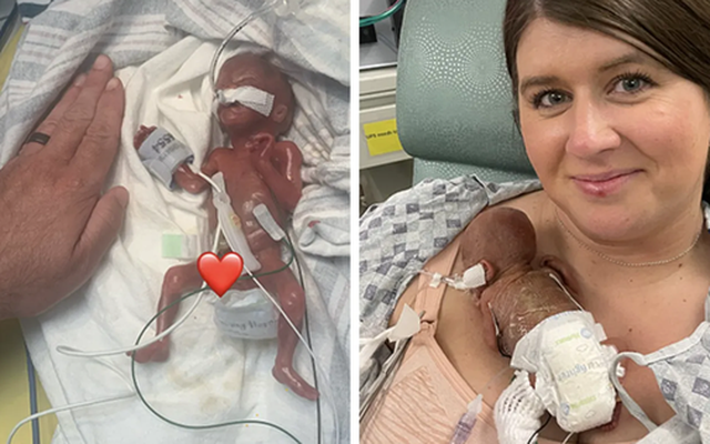 Em bé "sinh non nhất thế giới" nặng 285 gam, dài 24cm khi mới chào đời, sau 1 năm giờ ra sao?