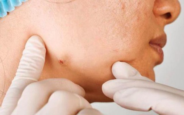 3 loại "mụn" này trên cơ thể có thể là ung thư, dù nam hay nữ, ở độ tuổi nào cũng đừng bỏ qua