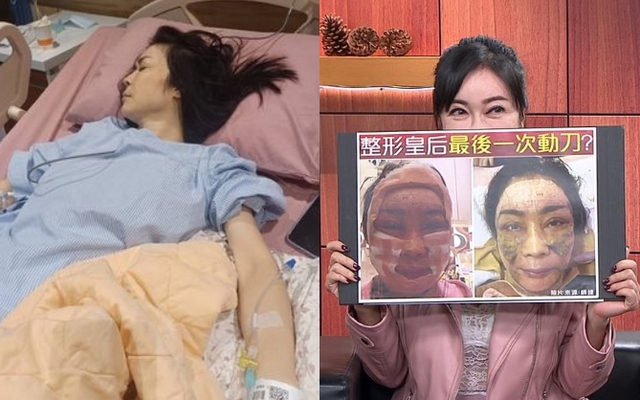 "Nữ hoàng dao kéo" chuyển từ giường bệnh ung thư sang… giường phẫu thuật thẩm mỹ, gây mê suốt 6 tiếng để căng da!