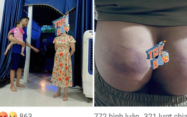 Công an xác minh thông tin cô giáo đánh học sinh bầm tím mông