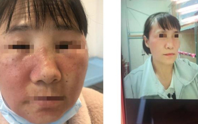 Người phụ nữ cấp cứu với khuôn mặt biến dạng: Bác sĩ thốt lên "tuyệt đối đừng dùng thứ này"